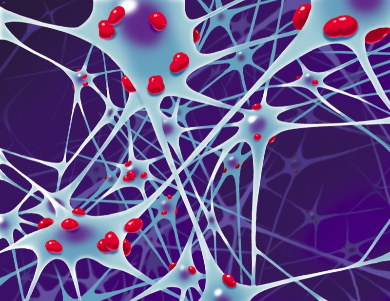 Alzheimer — illustrazione medica di Walter Pepperle, Francoforte sul Meno