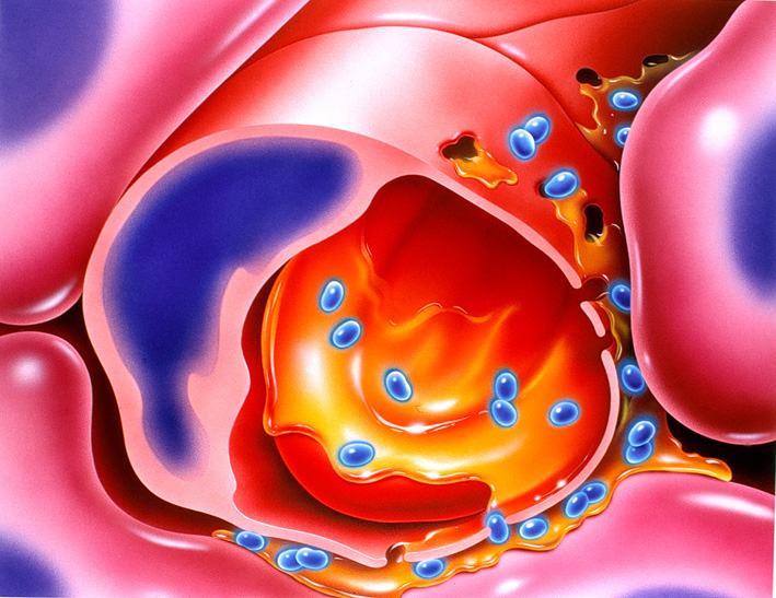 Capillary Leak — illustrazione medica di Walter Pepperle, Francoforte sul Meno
