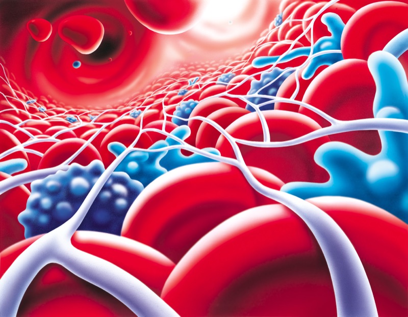 Thrombus — illustrazione medica di Walter Pepperle, Francoforte sul Meno
